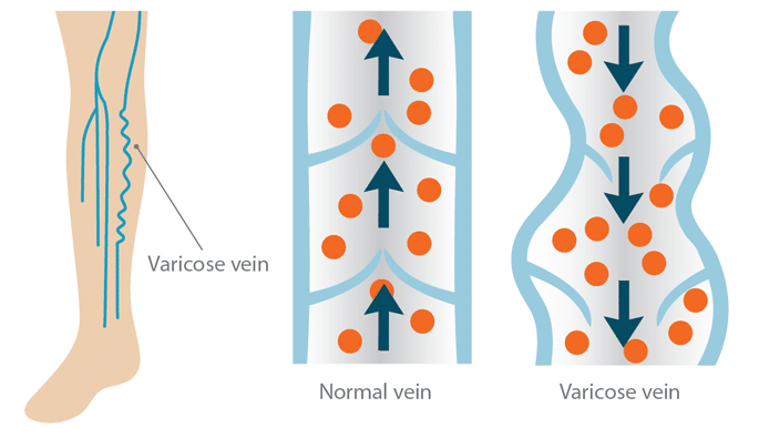 It's Time to Rethink Varicose Veins