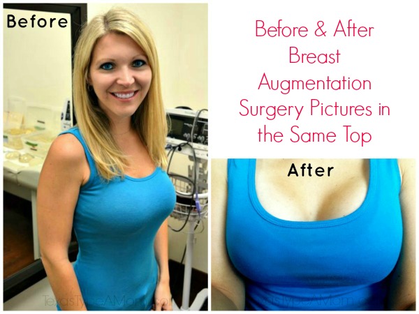 Before and After Breast Augmentation Sugery