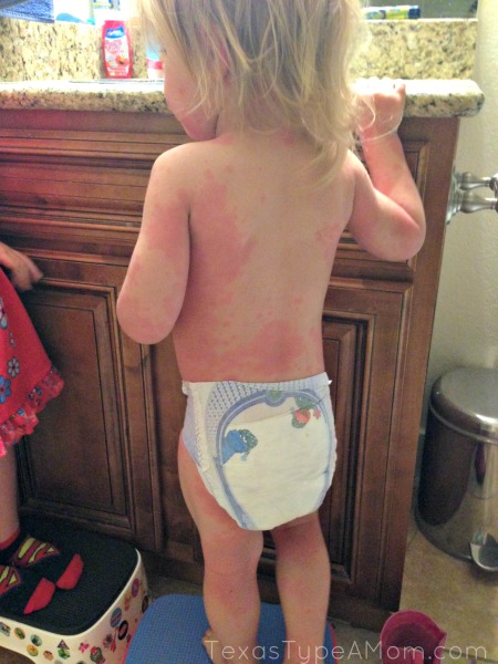 2-year-old-hives-on-back
