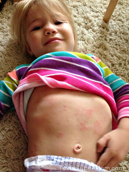 2-year-old-stomach-hives