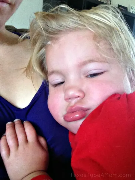 2-year-old-with-facial-swelling-hives