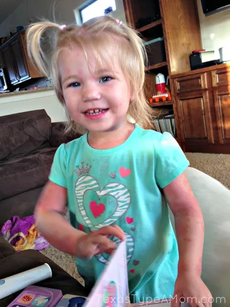 toddler-with-hives