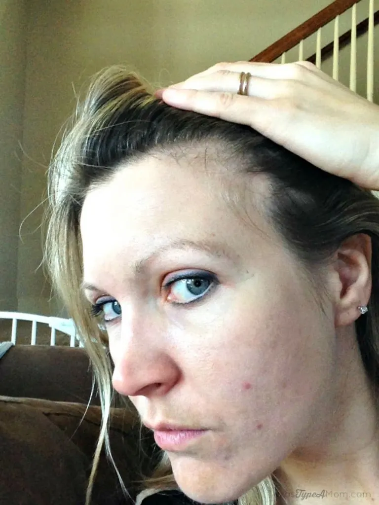 This is me. After testosterone wreaked havoc causing hair loss and acne. 