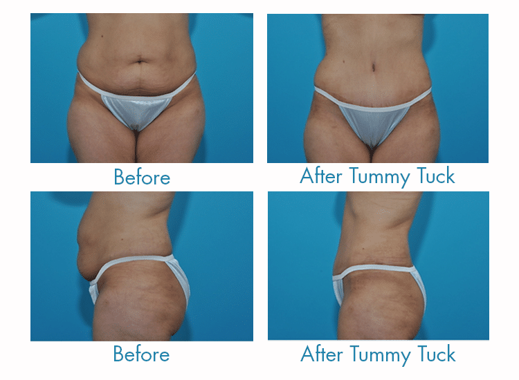 Pins can be deceiving. Is it weight loss or tummy tuck surgery you're seeing in those before and after photos? Here's a simple guide so you can tell.