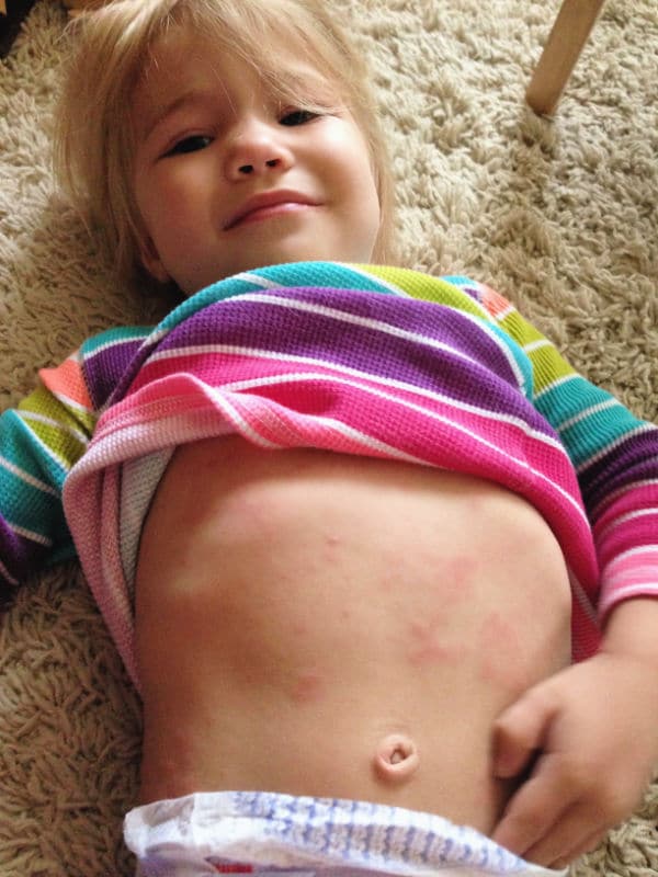 belly rash after febrile seizure