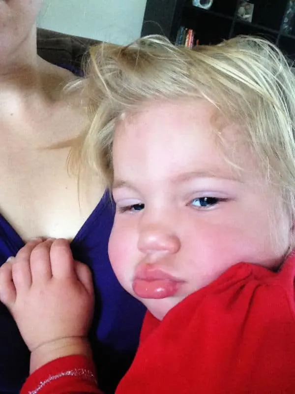 facial swelling in toddler before febrile seizure