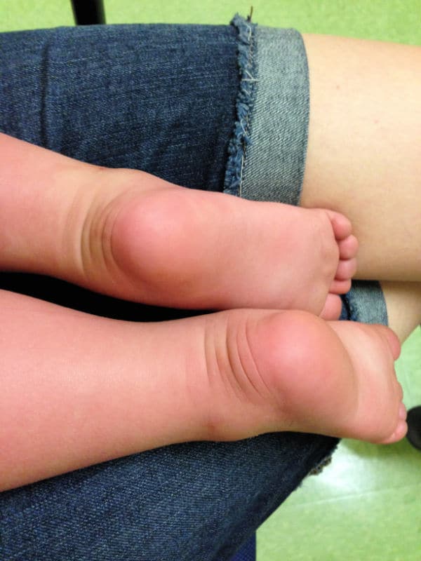 swollen feet on toddler febrile seizure