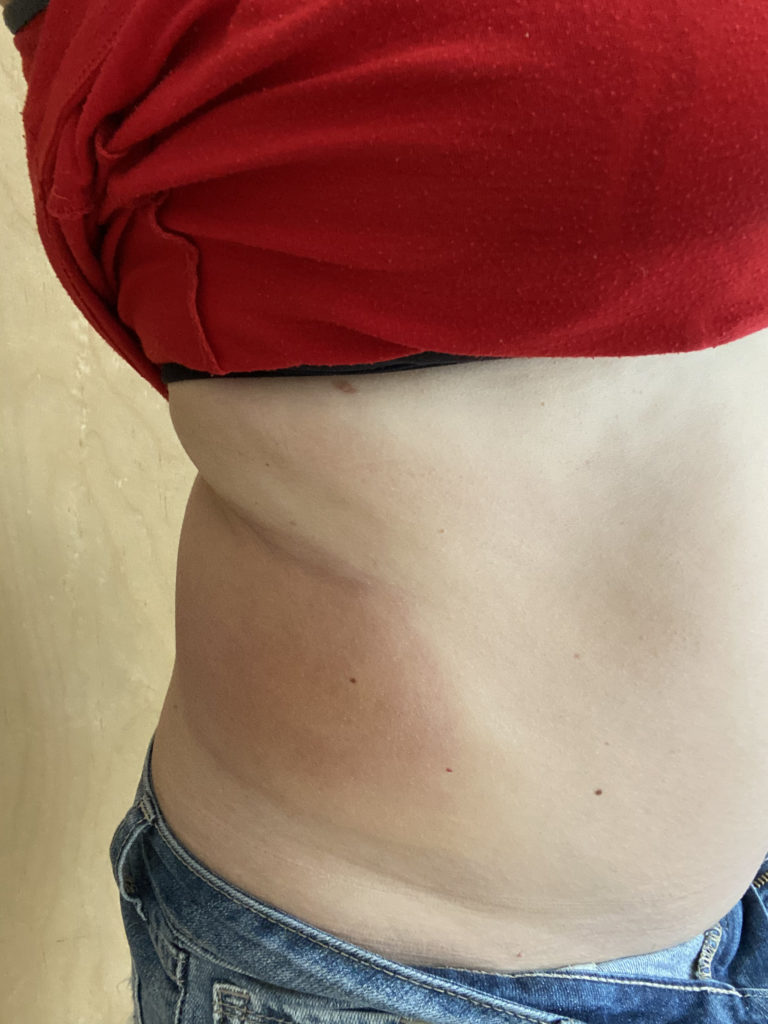 Photo 1 week after Coolsculpting flanks right side angle