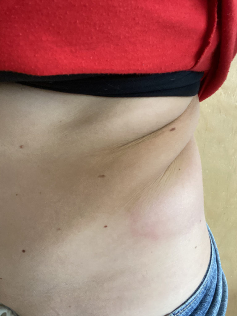 After Coolsculpting on left side - 1 week after results.