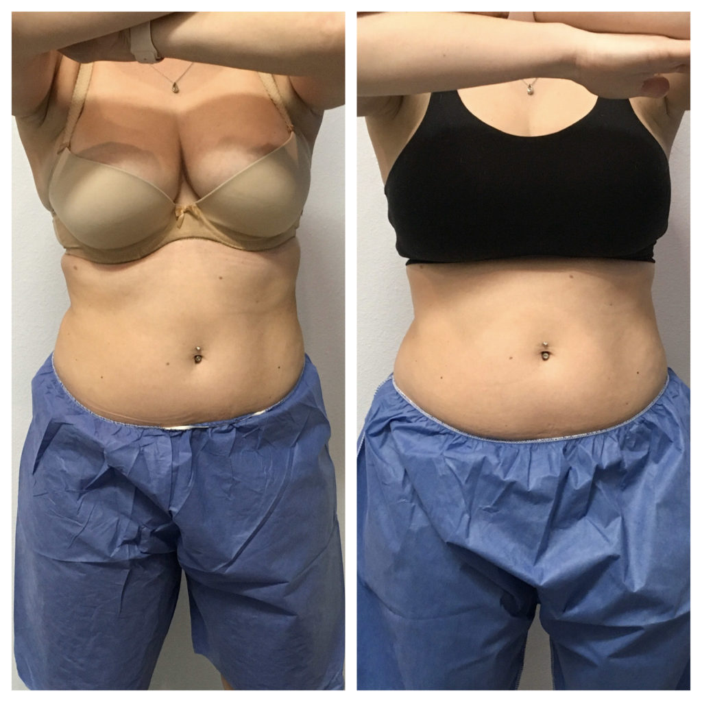 Back fat cool sculpting comparison from front of woman in bra and medical shorts.