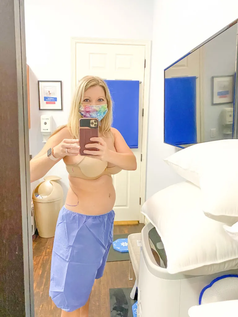 Woman with treament areas marked before first Coolsculpting appointment