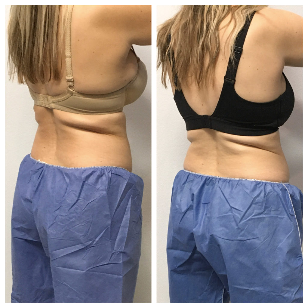 Coolsculpting Before and After Results & Review [Fat Freezing Results]