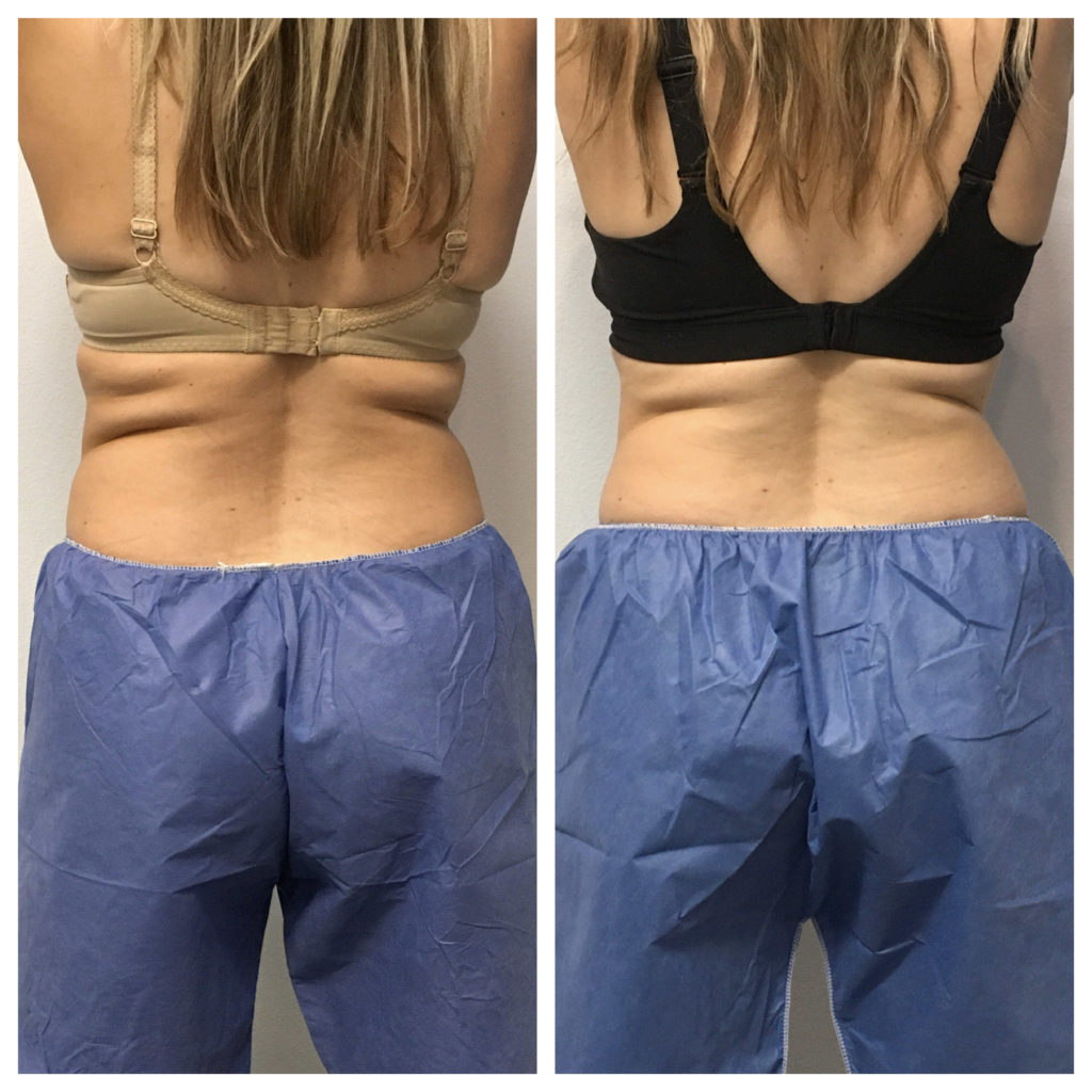 Back flanks of woman in side by side comparison of Coolsculpting progress